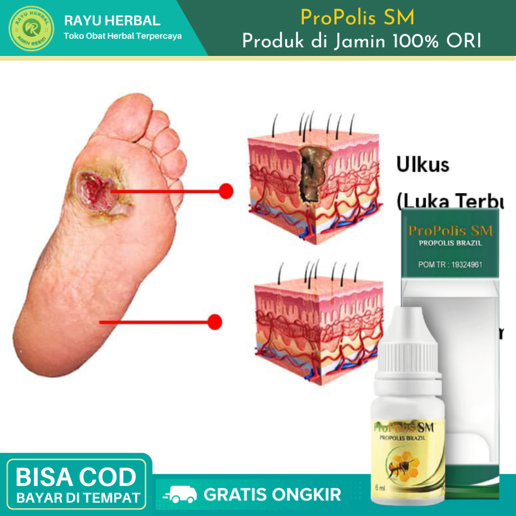 Jual Obat Pengering Luka Basah Bernanah Obat Luka Diabetes Obat Luka Sunat Obat Luka Bakar