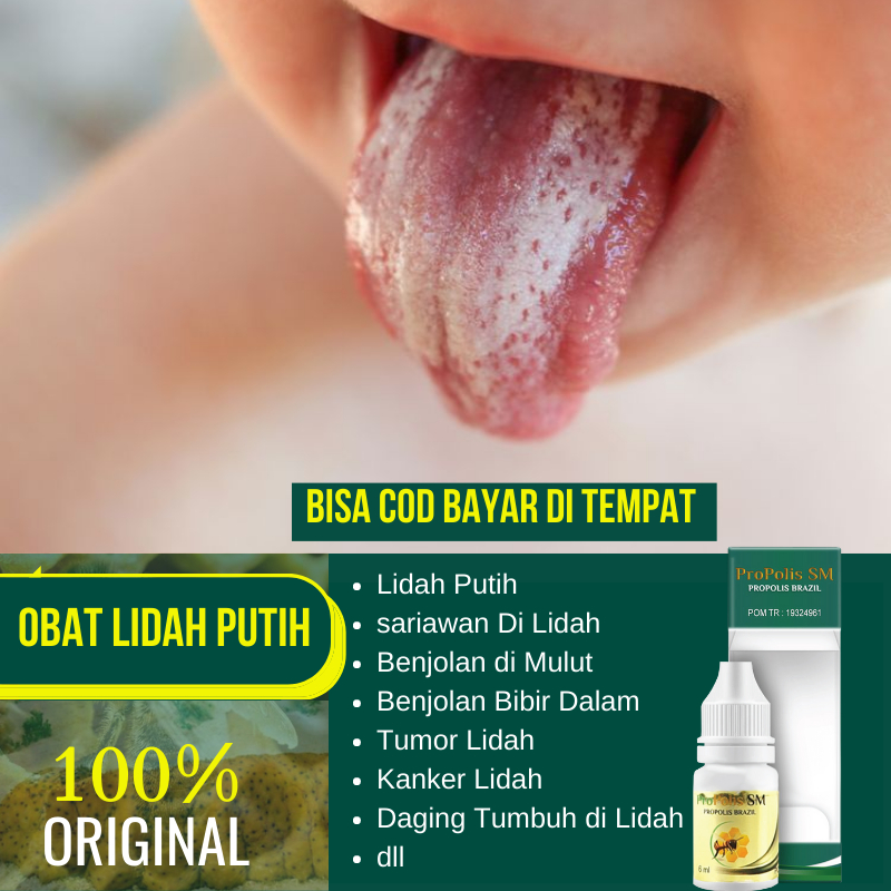 Jual Obat Lidah Putih Lidah Berjamur Lidah Pecah Radang Lidah