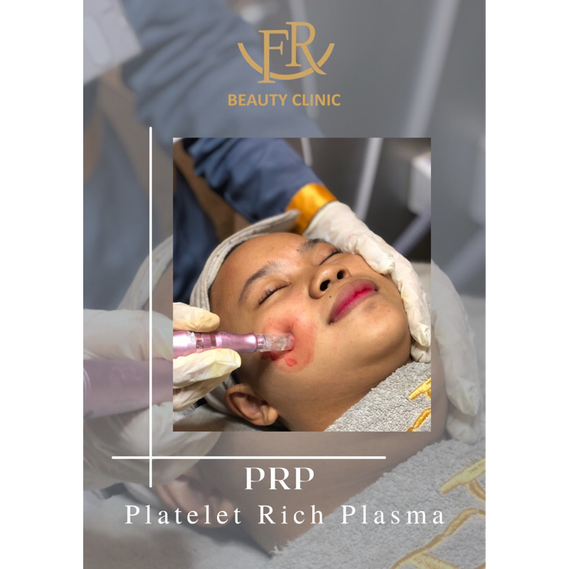 Jual PRP ( Platelet Rich Plasma ) | Shopee Indonesia