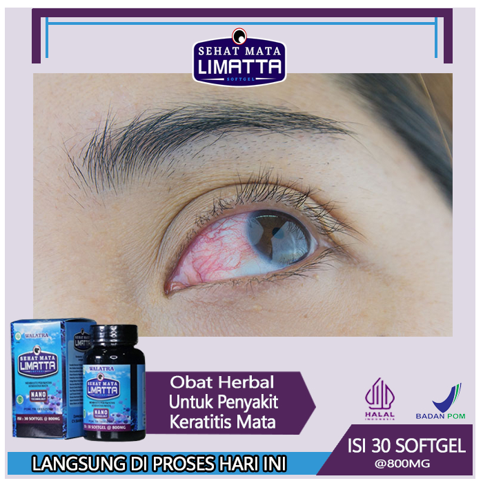 Jual Obat Keratitis Mata Peradangan Kornea Mata Mata Merah Dan Sakit