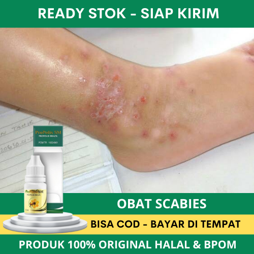 Jual Obat Gatal Scabies, Obat Penghilang Scabies, Obat Gatal Kulit ...