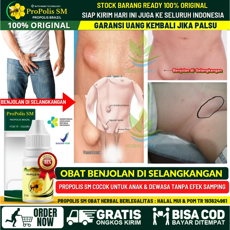 Jual Salep Sekelan di Selangkangan, Obat Oles Pengempis Benjolan Abnormal di  Selangkangan, Obat Tradisional Benjolan Sekelan di Paha, Sekelan di Ketiak,  Sekelan di Leher, Sekelan di Kaki, Benjolan Pembengkakan Kelenjar Getah  Bening -