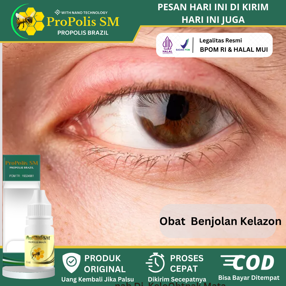 Jual Obat Penghilang Benjolan Kalazion, Benjolan Di Kelopak Mata, Mata ...