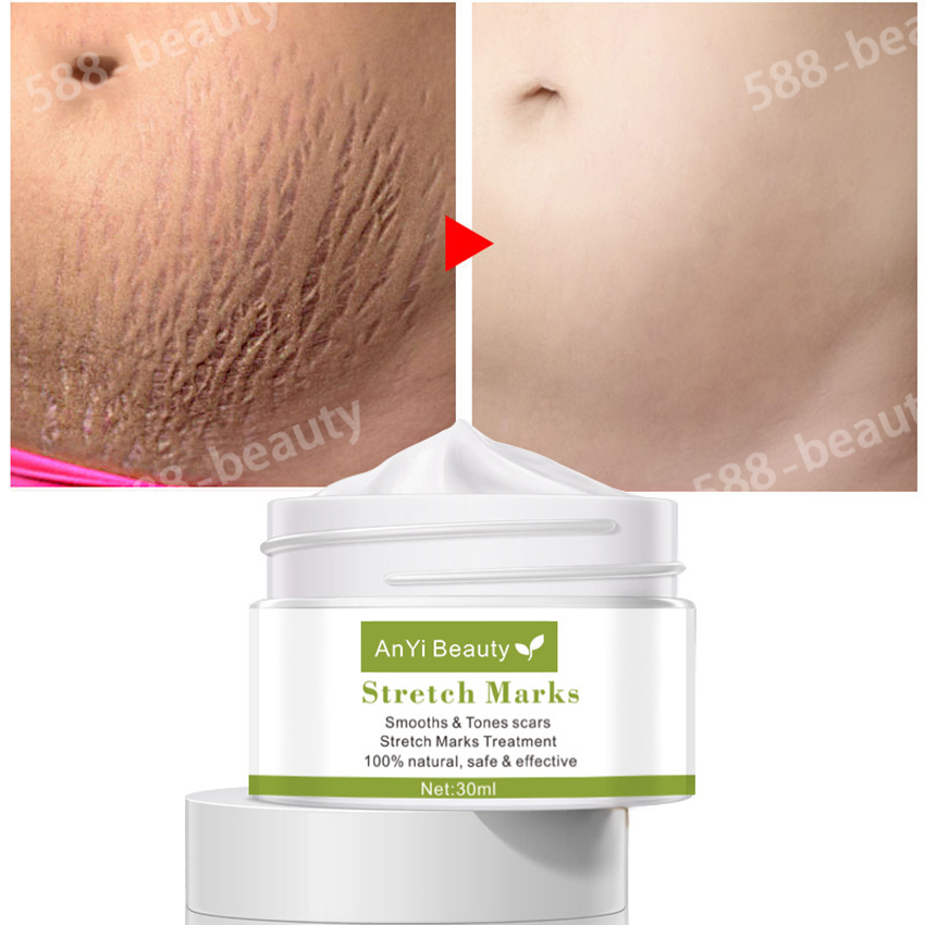 Jual Krim penghilang stretch mark, lotion stretch mark, krim bekas luka