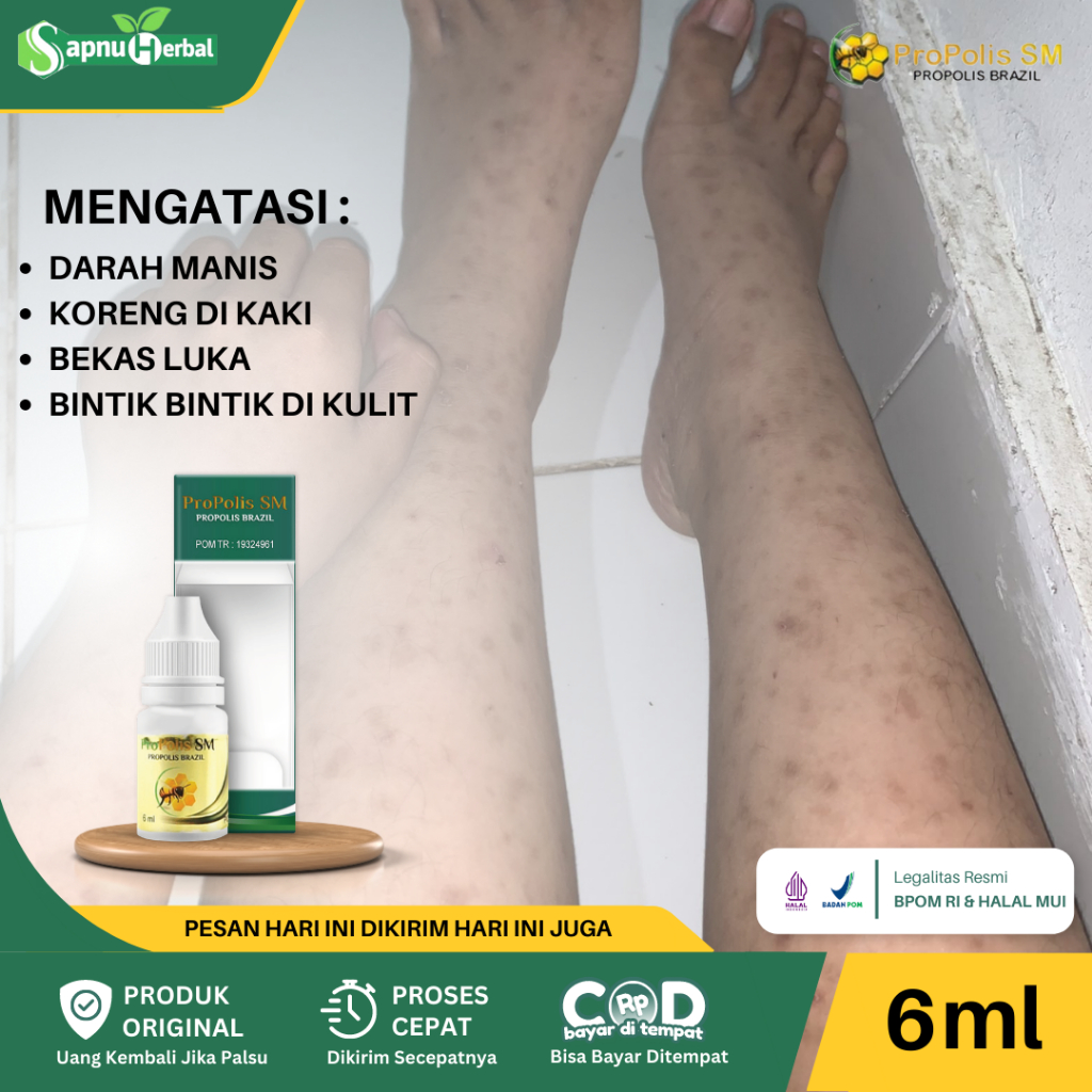 Jual Obat Darah Manis Prurigo Gatal Kulit Kulit Korengan Peradangan