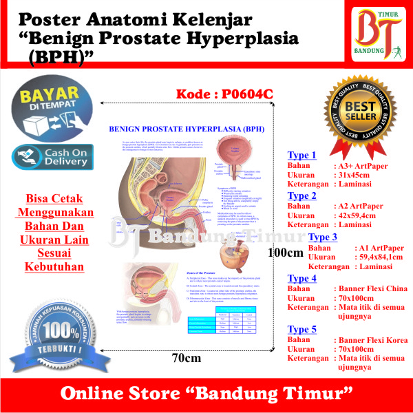 Jual Poster Anatomi Kelenjar Benign Prostate Hyperplasia Bph Shopee