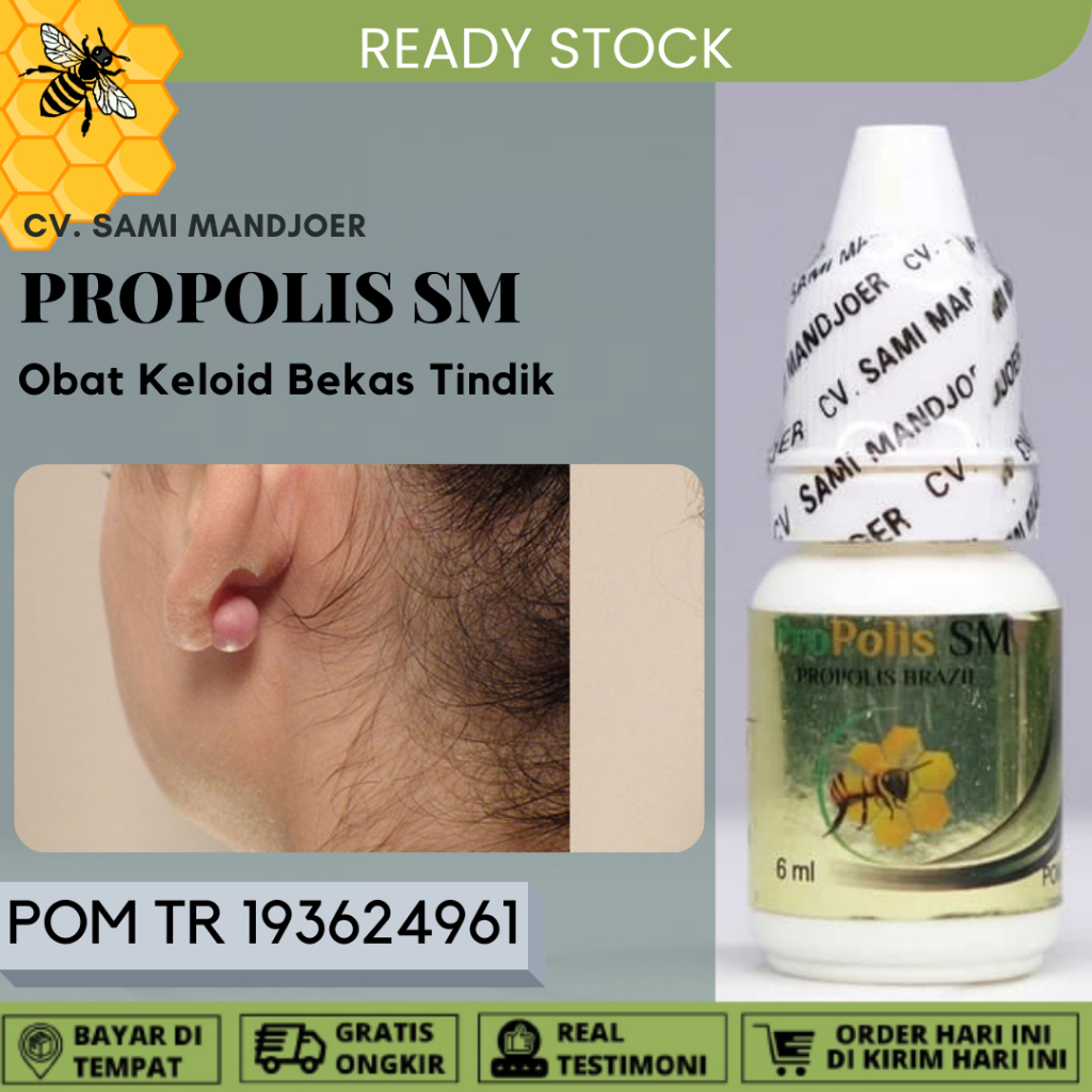 Jual Obat keloid, Obat Keloid Luka Tindik, Penghilang keloid Daging