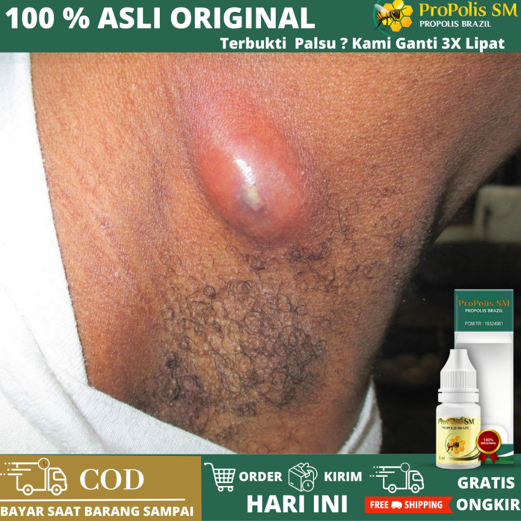 Jual Obat Penghancur Benjolan Lipoma, Obat Penghancur Benjolan Lipoma