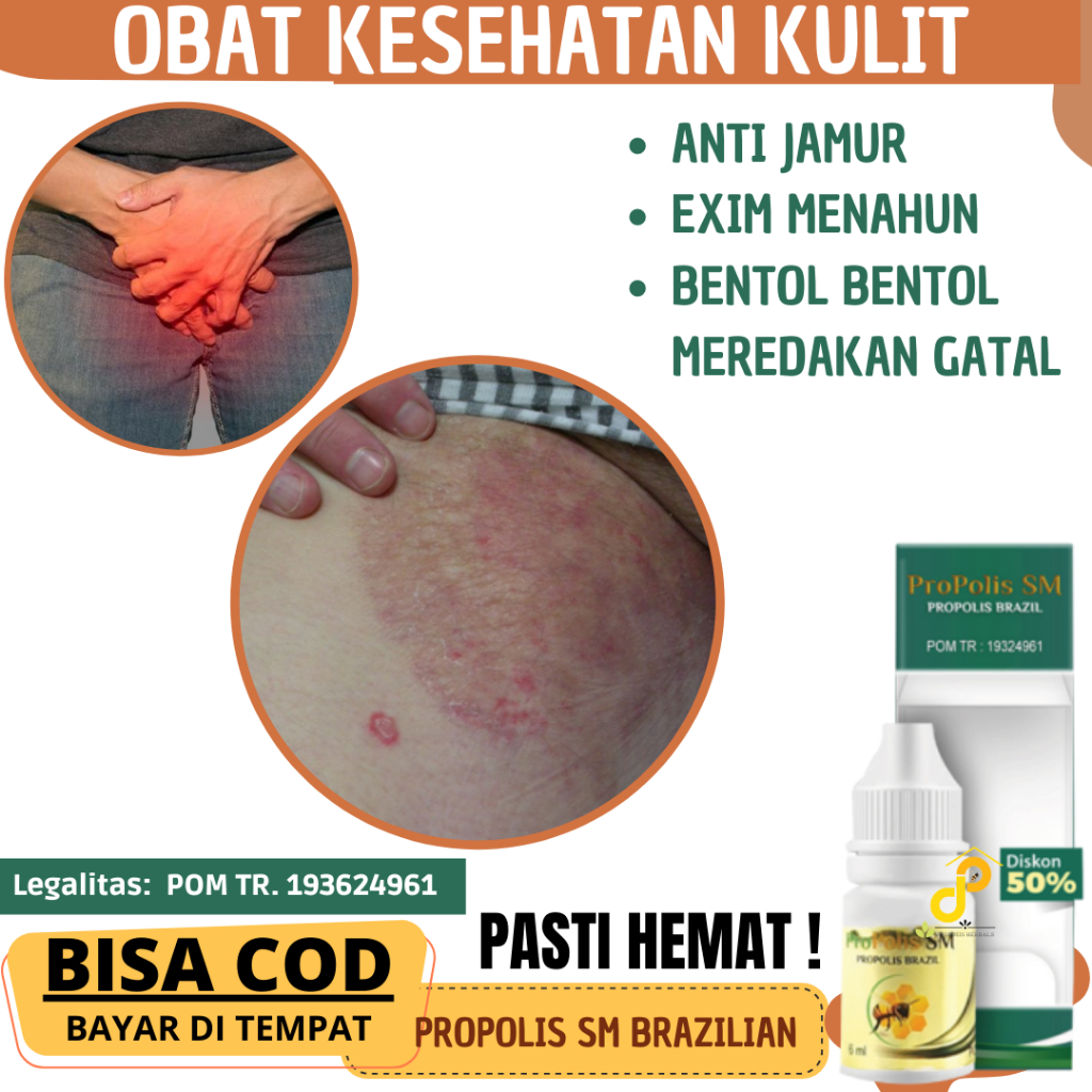 Jual [PSM] obat bentol di pantat, muncul bentol gatal pada kemaluan ...