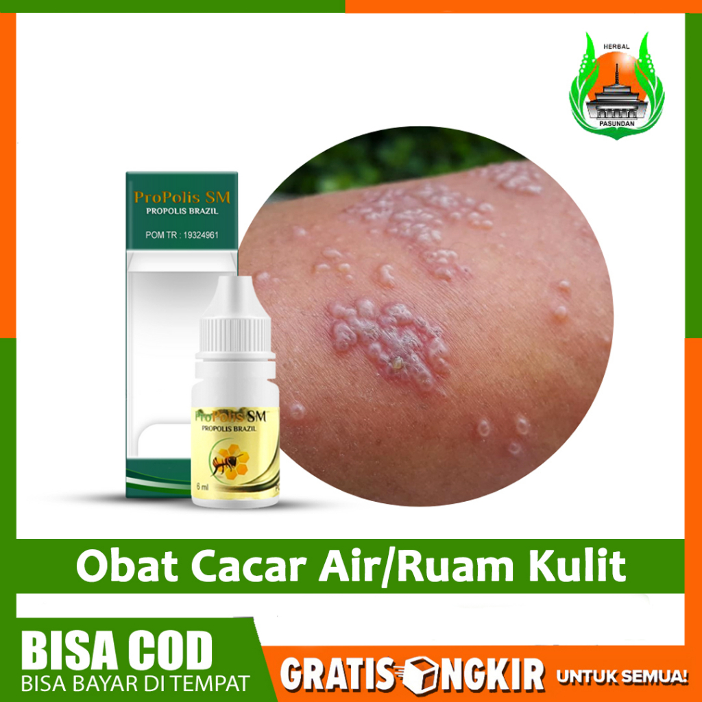 Jual Obat Cacar Air Ruam Merah Kulit Gatal Berair Herbal Propolis SM ...
