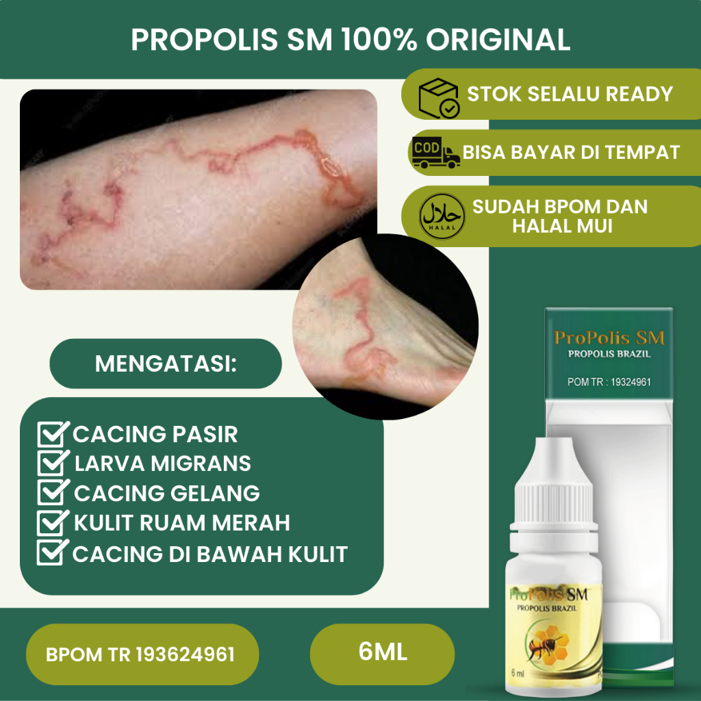 Jual Obat Cacing Pasir Cacing Pasir Di Kulit Larva Cacing Pasir Cutaneous Larva Migrans