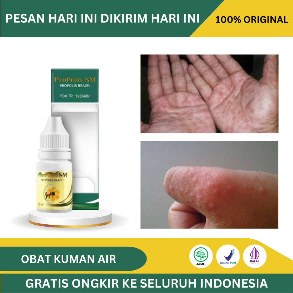 Jual Obat Oles Telapak Tangan Gatal Bintik Berair Di Tangan Obat Kuman Air Telapak Tangan 4642