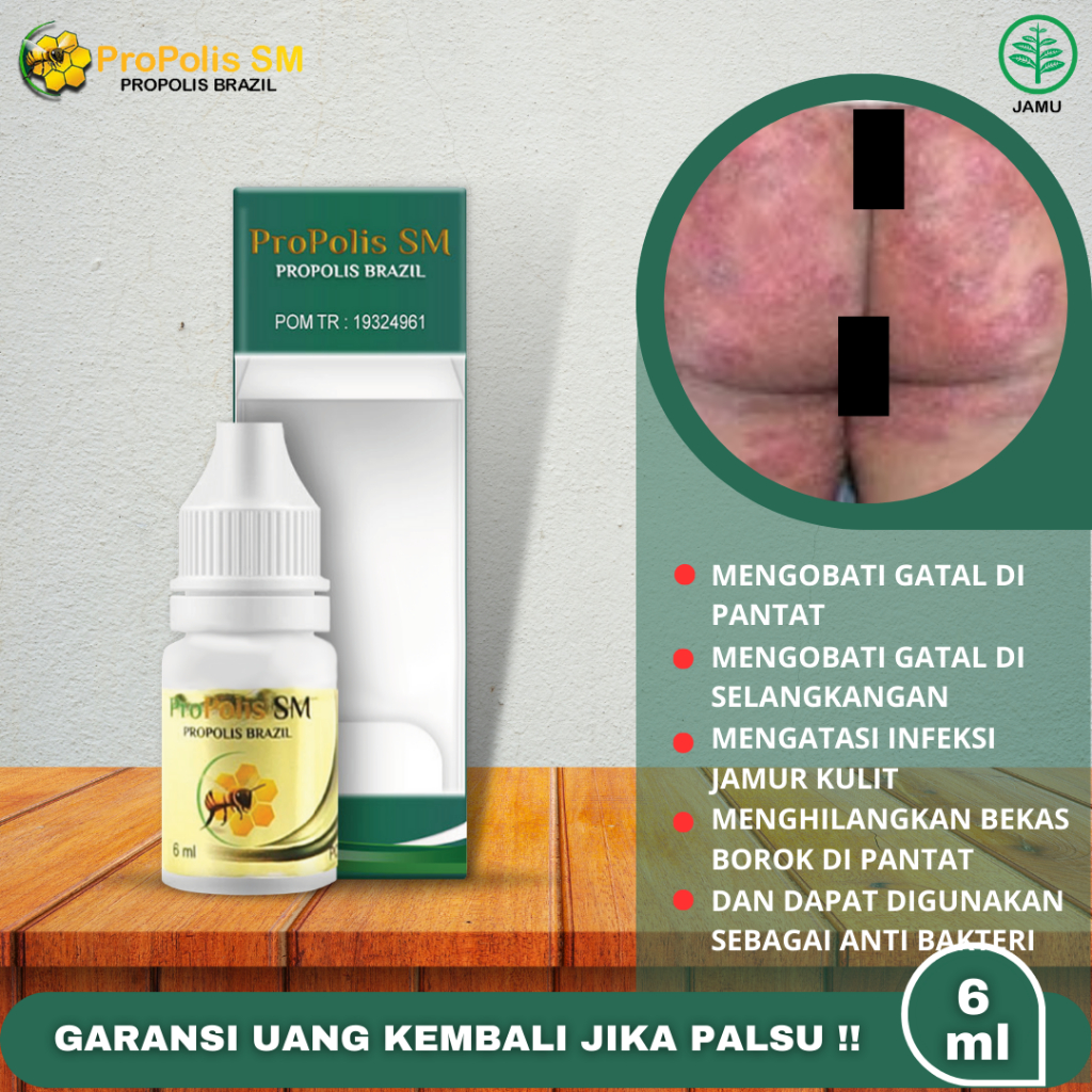 Jual Obat Oles Gatal Pantat Dan Selangkangan Pantat Bruntusan Pantat