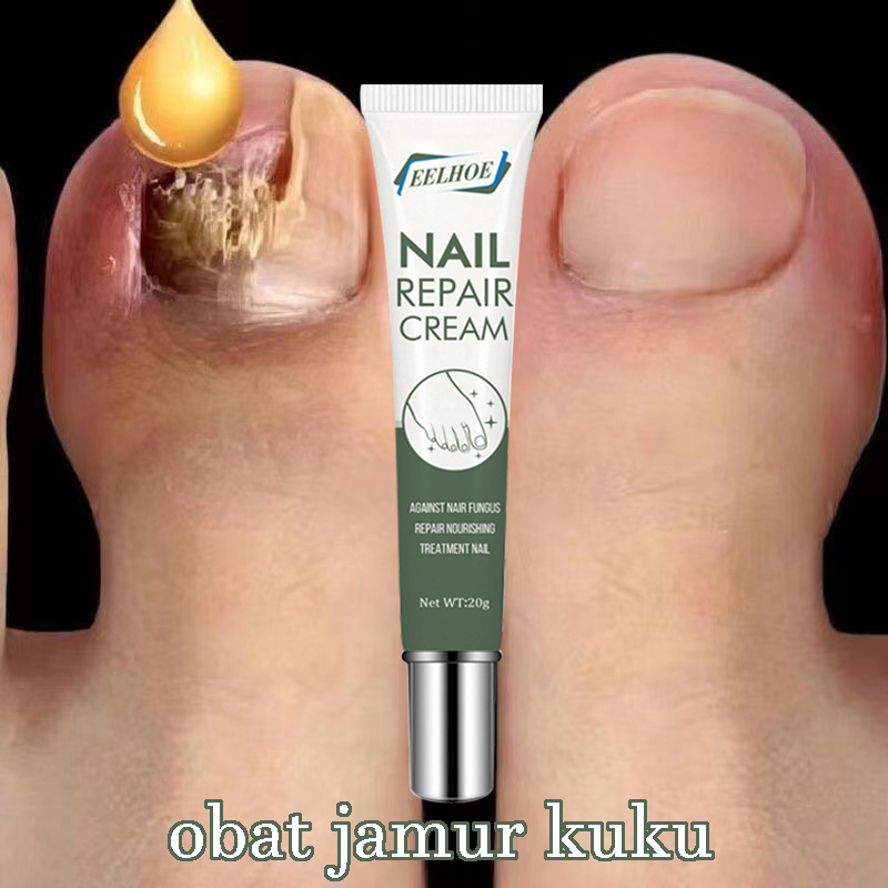 Jual G Obat Kuku Jamur Dan Rusak Perawatan Esensi Serum Paronychia Perawatan Penghilang Jamur