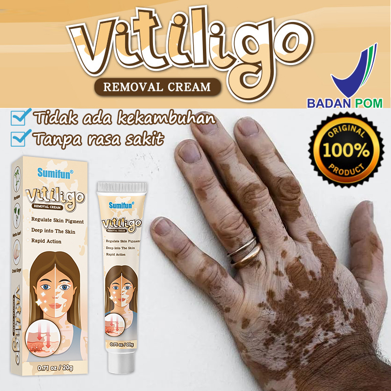 Jual [100 ORIGINAL] Obat white spot Salep vitiligo 20g Tidak ada