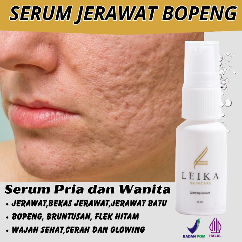 Jual Ampuh Penghilang Bekas Jerawat Pria Permanen Bpom Paling Ampuh ...