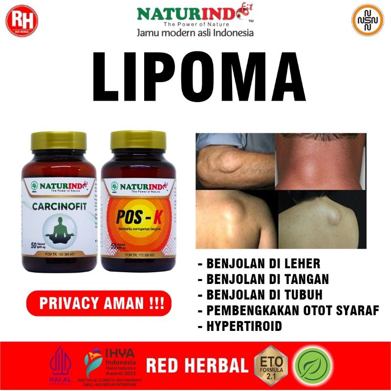 Jual Obat Benjolan Lipoma Kelenjar Di Leher Ketiak Payudara Kepala Kaki