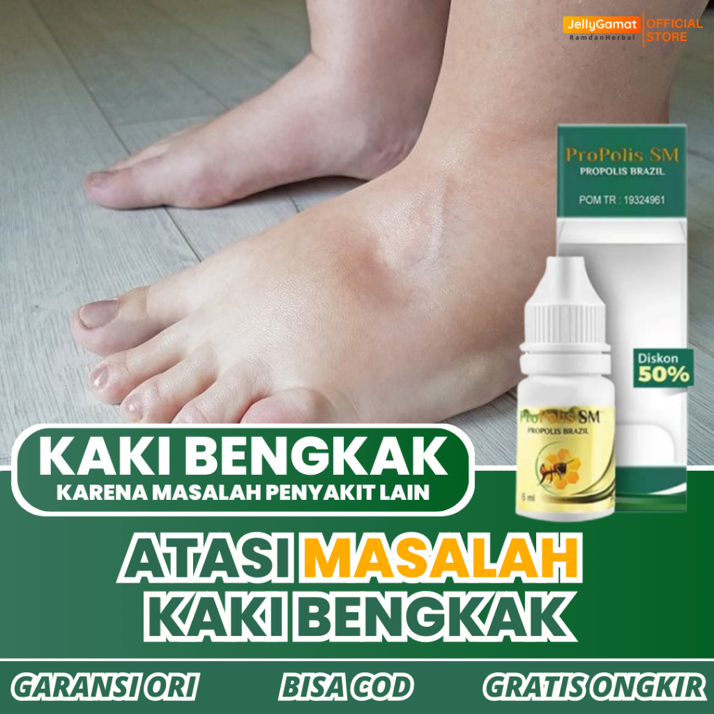 Jual [COD] Obat Kaki Bengkak Di Apotik, Kaki Bengkak Karena Jantung