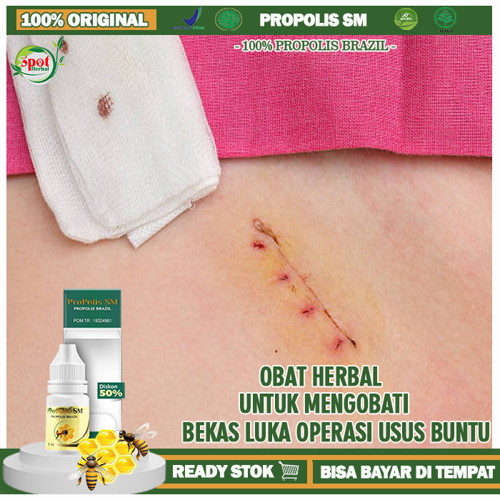 Jual Obat Pengering Luka Operasi Usus Buntu Dari Dalam, Obat Pengering