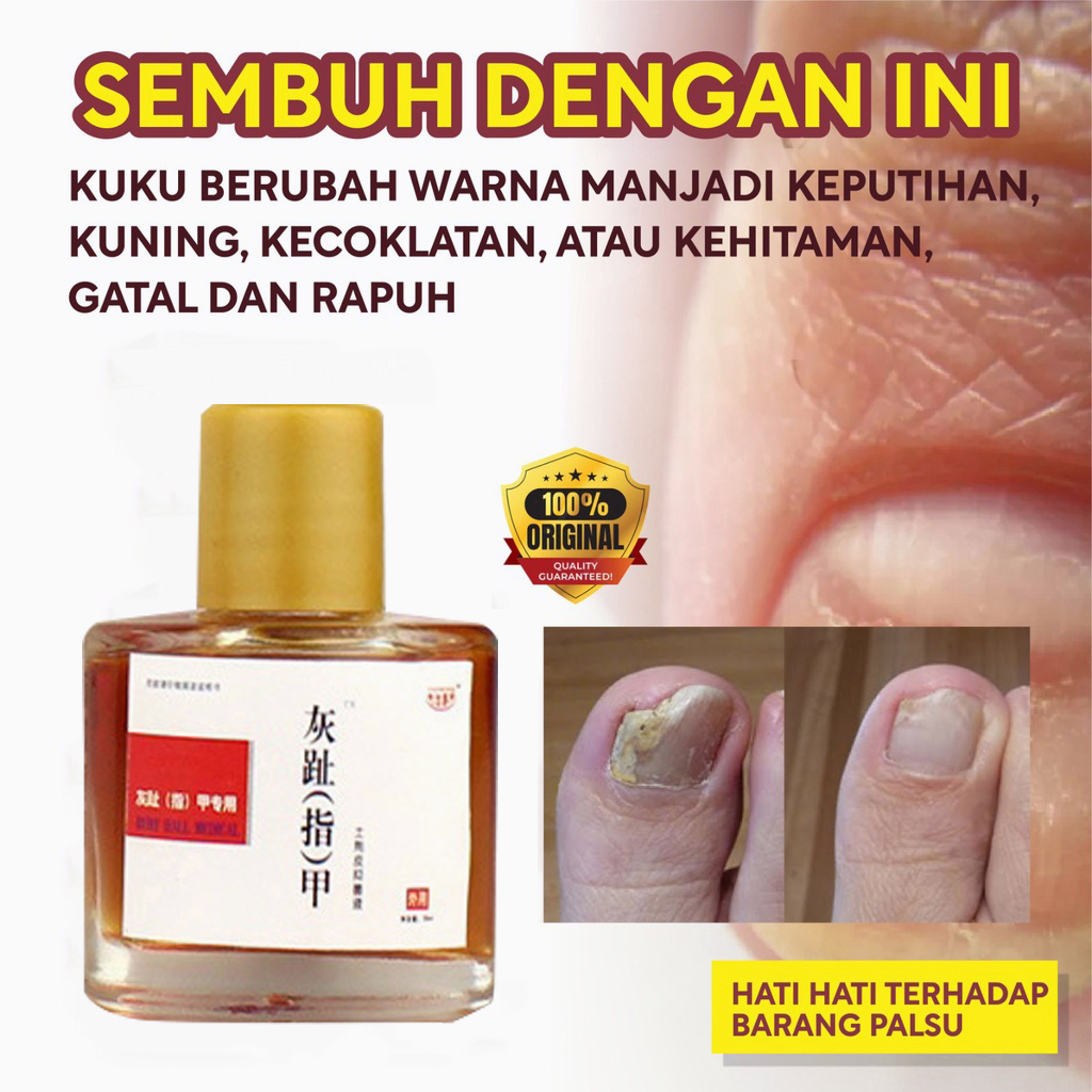 Jual Obat Jamur Kuku Perawatan Jamur Kuku Perawatan Kuku Kaki Ml Obat