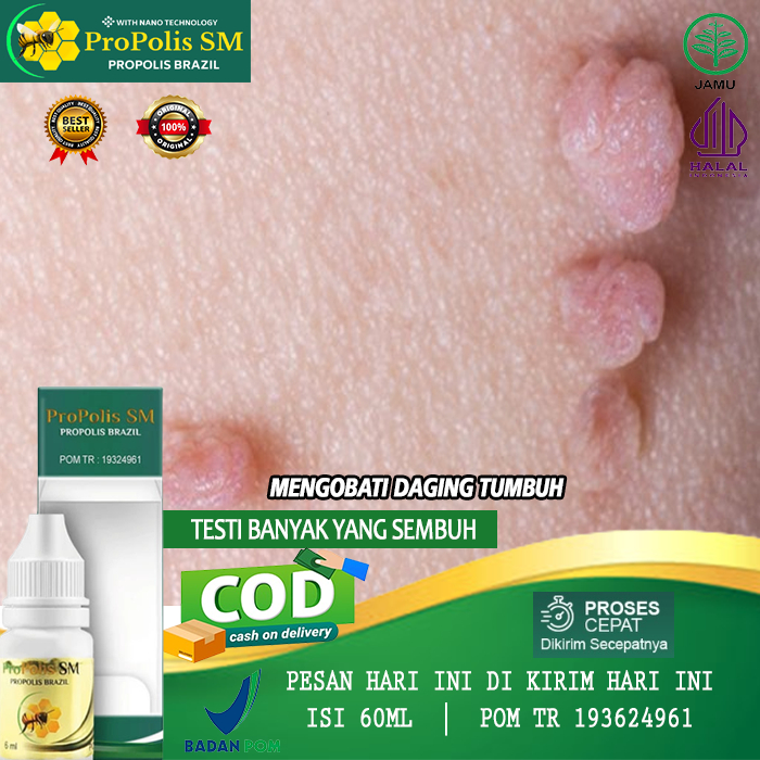 Jual Obat Penghilang Kutil Daging Jadi Obat Keloid Daging Tumbuh Obat