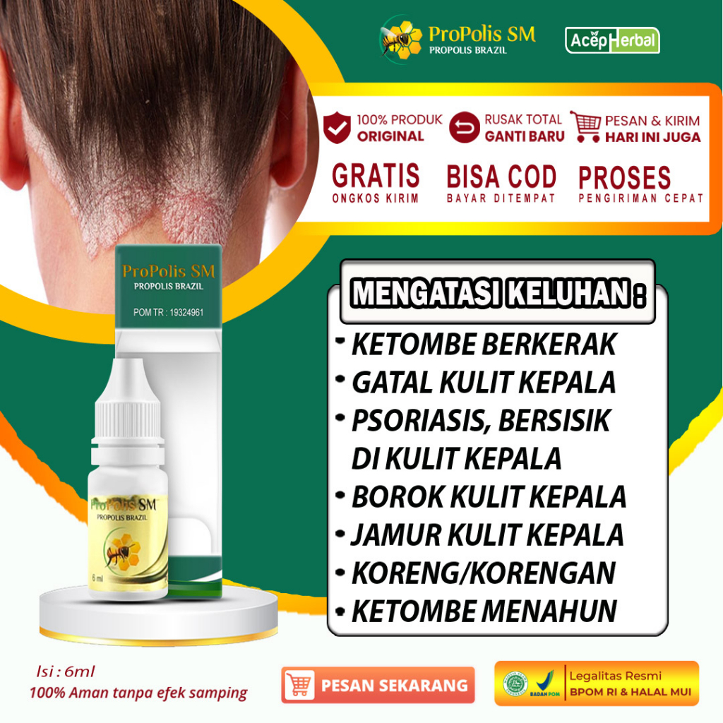 Jual Obat Ketombe Berkerak Kulit Kepala Pengilang Ketombe Parah