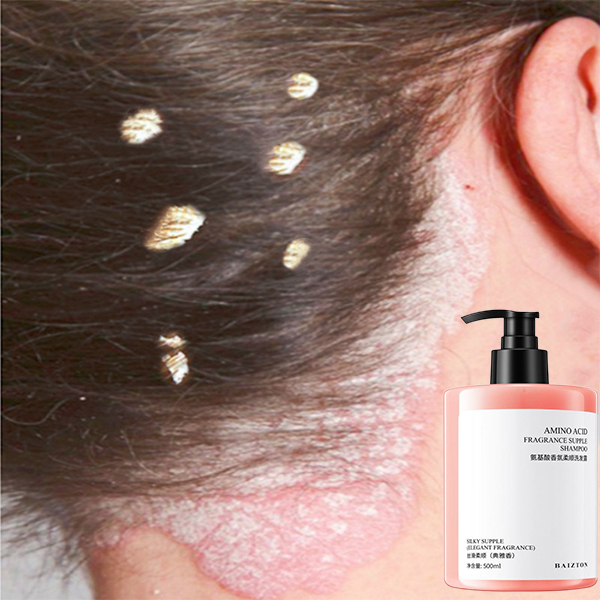 Jual shampoo anti ketombe shampo anti ketombe Shampo anti gatal dan