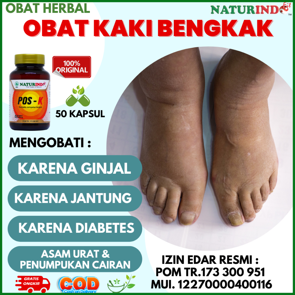 Jual Obat Kaki Bengkak Herbal Ampuh Diabetes Saraf Penyumbatan Darah