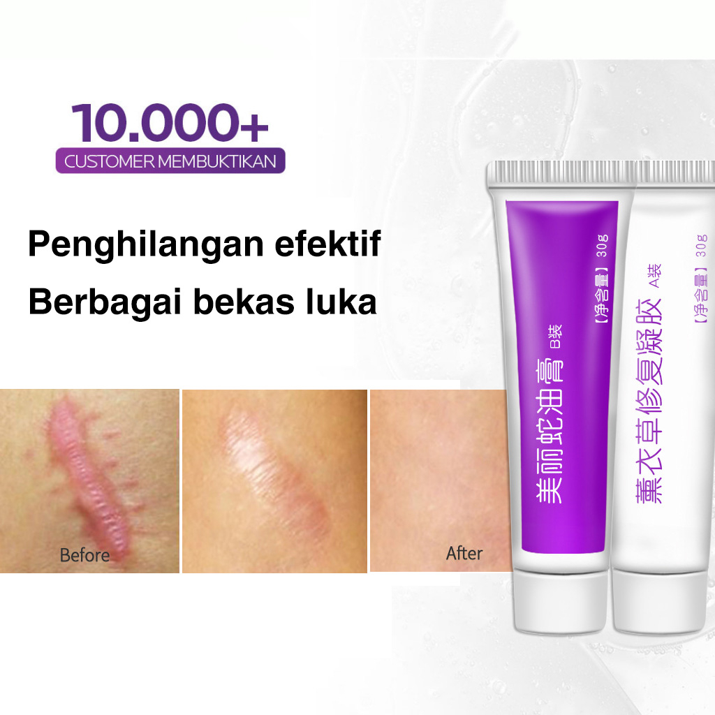 Jual Cream Penghilang Bekas Jerawat | Bopeng,dan Flek | Penghilang ...