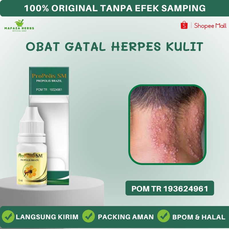 Jual Mafaza Herbs - Obat Gatal Herpes, Obat Herpes Kulit, Obat Herpes ...