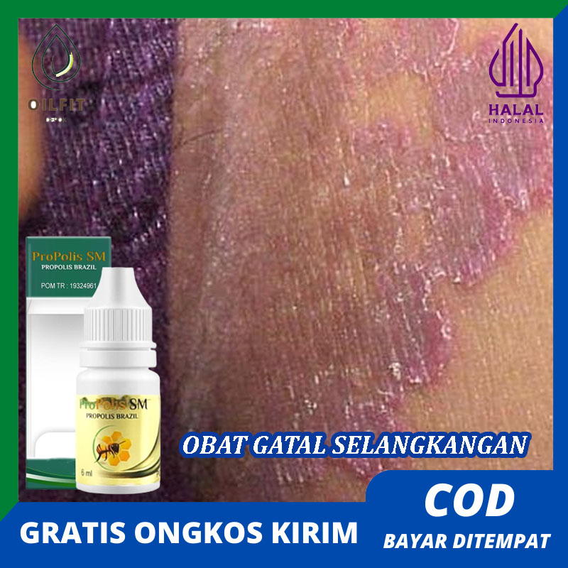 Jual Obat Selangkangan Gatal dan Hitam Berjamur Jamuran Bersisik Bintik ...