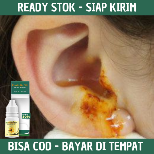 Jual Obat Telinga Curek Berair Dan Bau Congek Telinga Bernanah