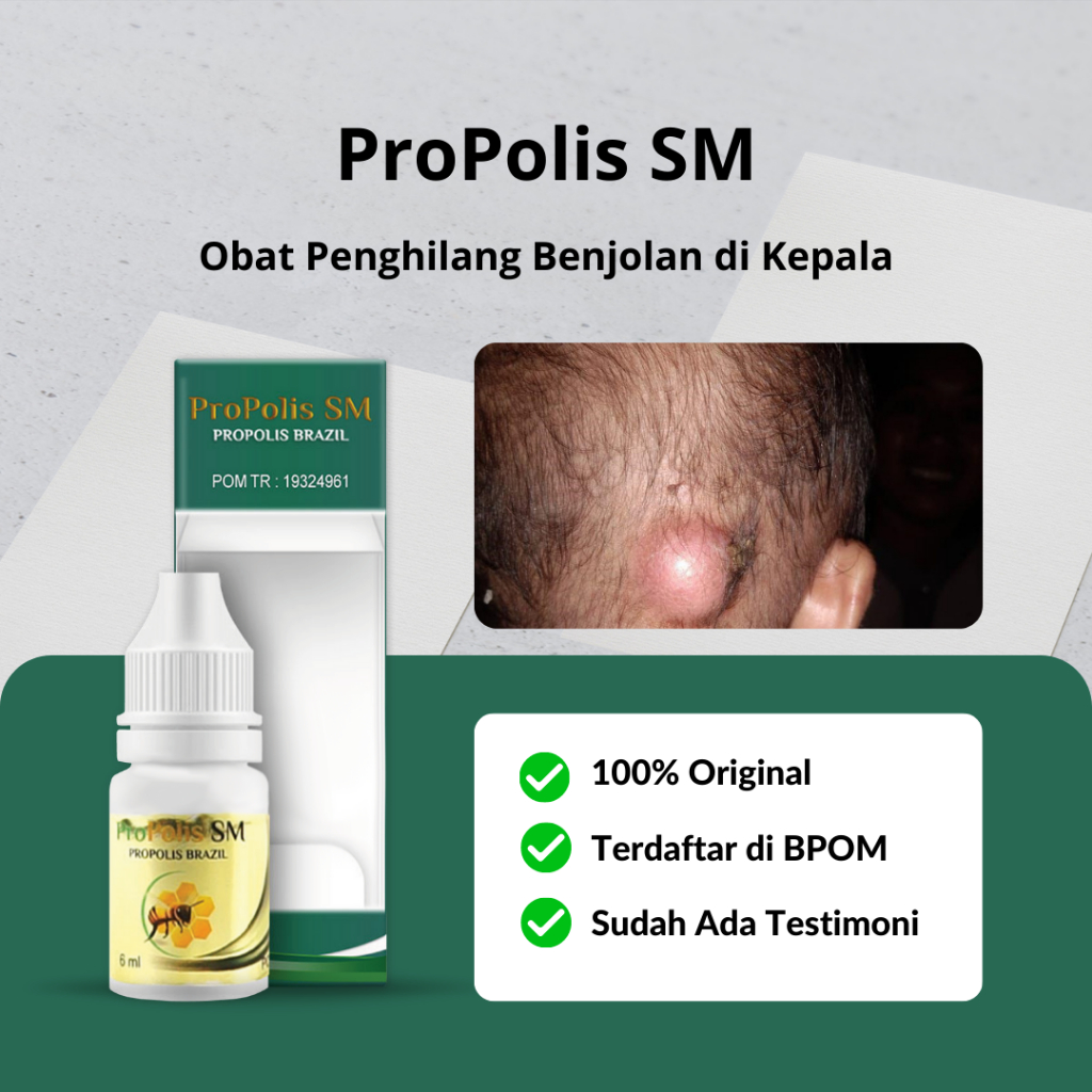 Jual Propolis SM - Obat Benjolan Di Kepala, Jidat / Kening, Obat ...