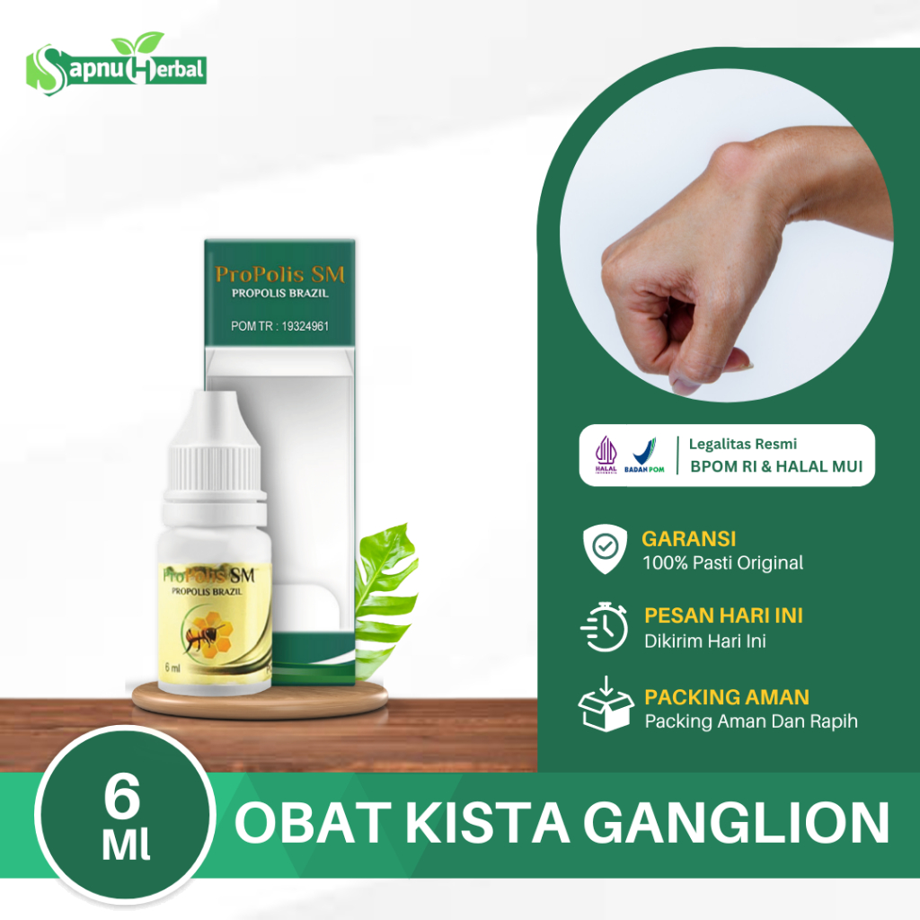 Jual Obat Penghancur Benjolan Ganglion Kista Ganglion Benjolan Di Tangan Benjolan Lipoma 8681