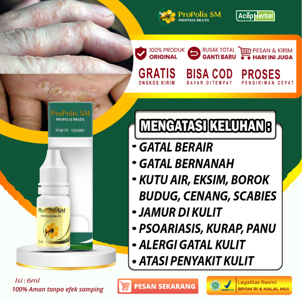 Jual Obat Gatal Berair Di Jari Tangan Dan Kaki Sela Jari Bintik Berair Bernanah Kutu Air Salep 1474