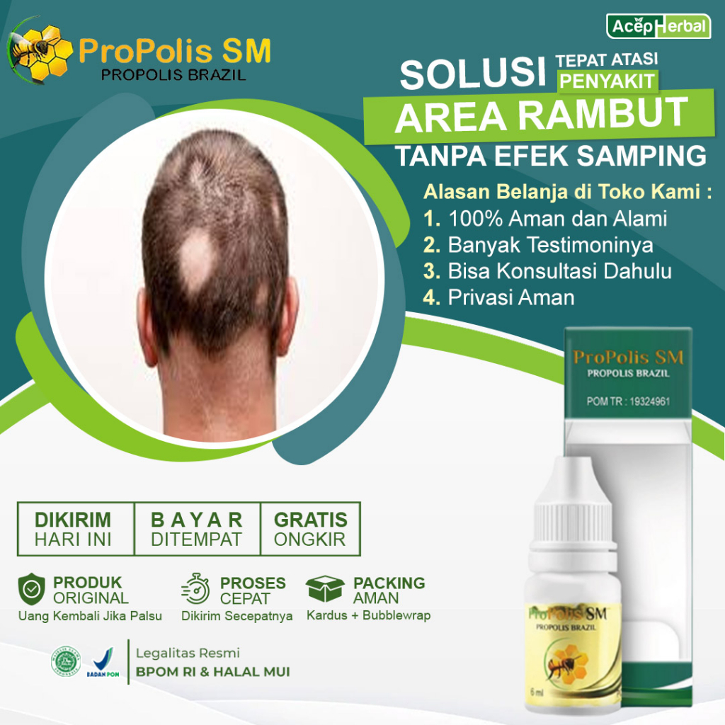Jual Obat Alopecia Areata, Obat Oles Penumbuh Rambut Rontok,Obat