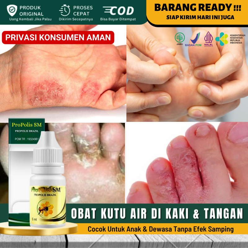 Jual Obat Tradisional Gatal Lecet Di Sela Sela Jari Tangan Kaki Akibat Kutu Air Gatal Kulit