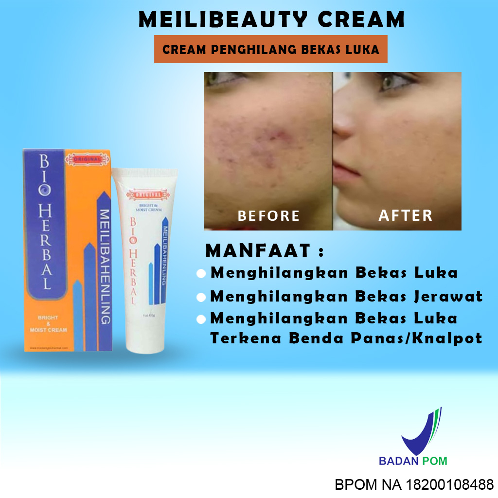 Jual Penghilang Bekas Luka Hitam Jerawat Koreng dan Keloid Salep Cream