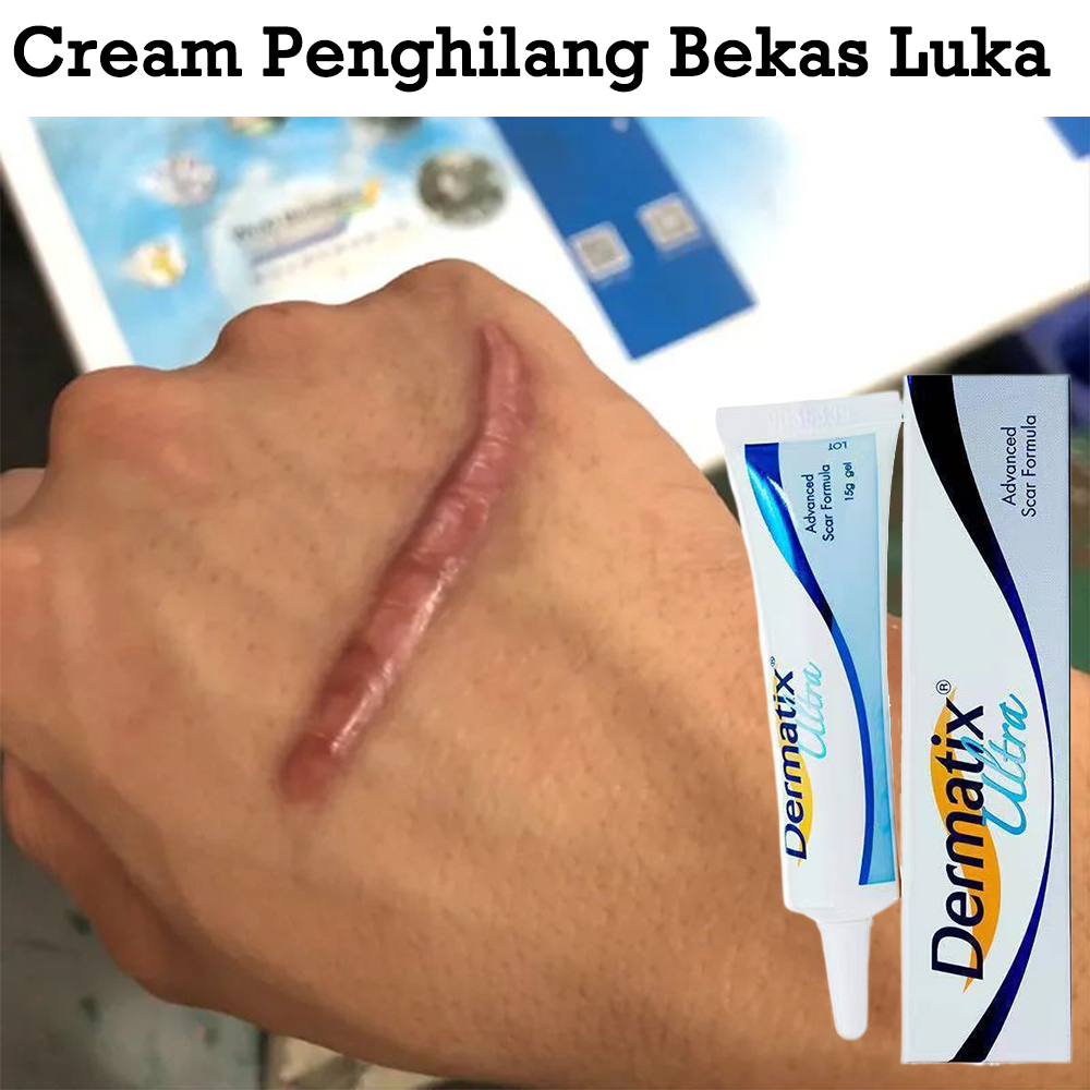 Jual Dermatix Ultra Obat Penghilang Bekas Luka Cream Penghilang Bekas