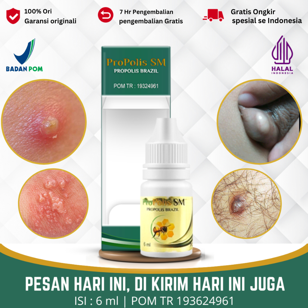 Jual Obat Kista Benjolan Di Kemaluan Wanita / Pria, Kista epididimis