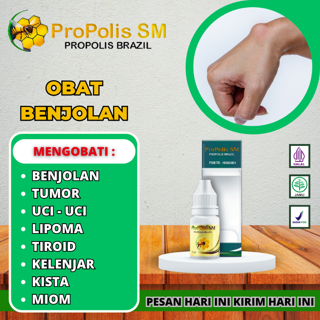 Jual Obat Menghilangkan Benjolan Di Tangan Kista Ganglion Benjolan Di ...