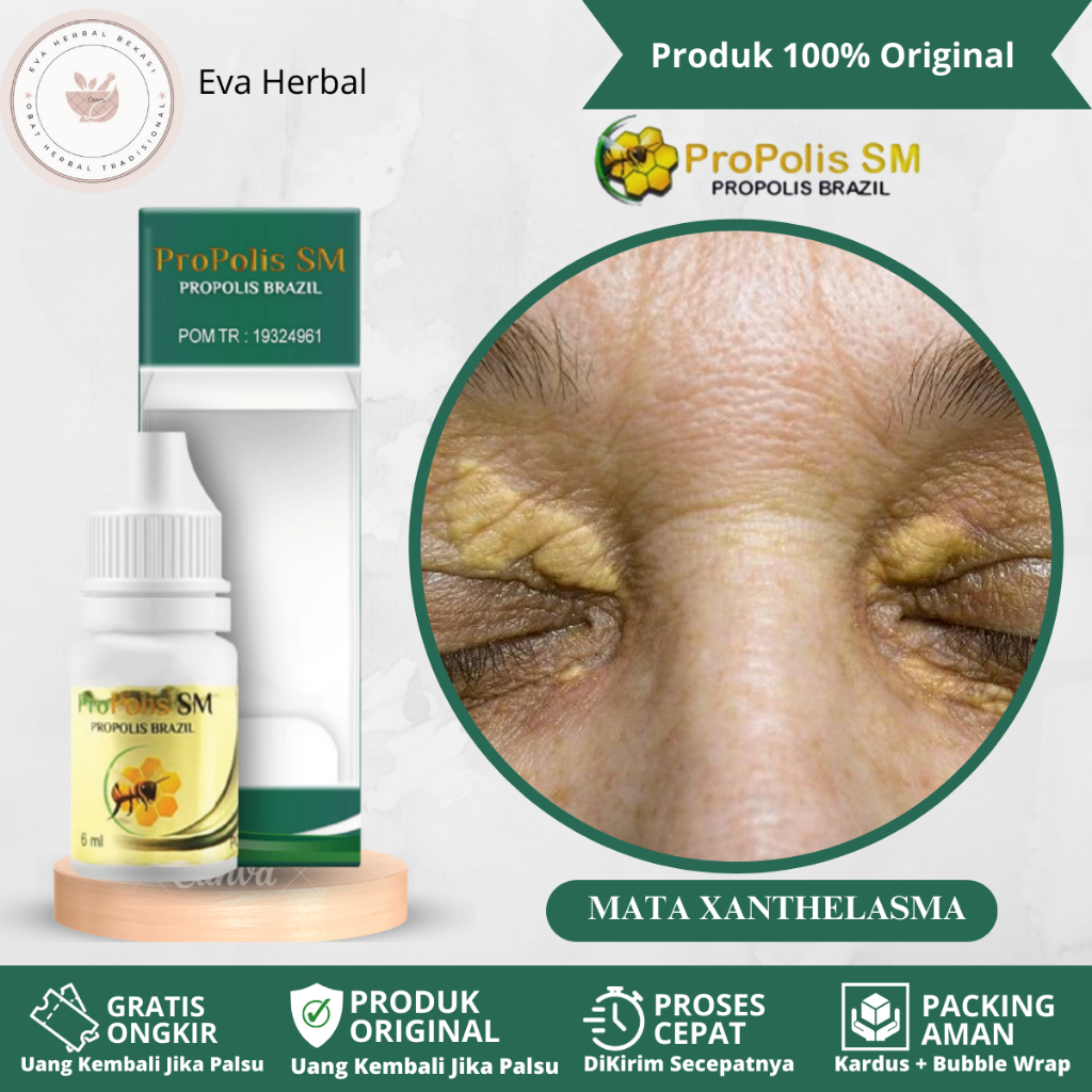 Jual Obat Xanthelasma, Obat Oles Penghilang Xanthelasma, Obat Gumpalan ...