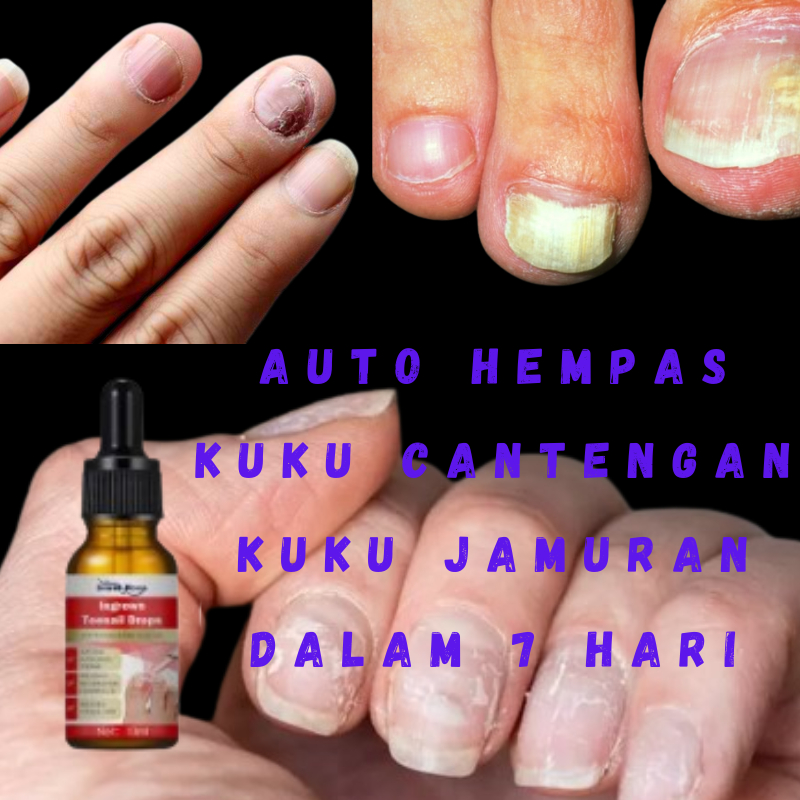 Jual [hot Promo] Obat Cantengan Jempol Kuku Kaki Tangan Bengkak