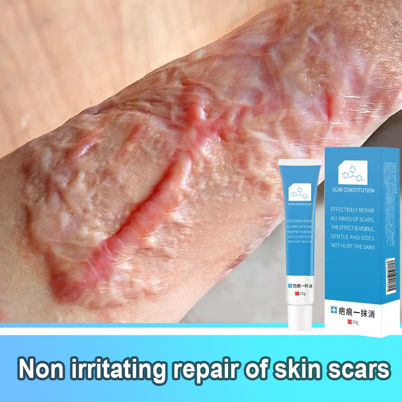 Jual 伤疤去除膏 Scar acne remover scars face Repair Cream for old scar on leg pimple pimples acne