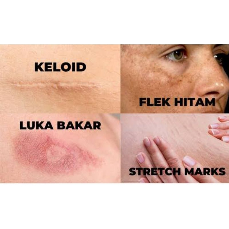 Jual Dermakel Gel 19 gram Penghilang Bekas Luka/keloid/Scar Bopeng ...