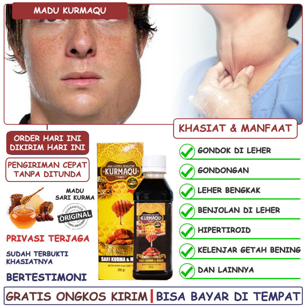 Jual Obat Gondok Gondongan Kelenjar Getah Bening Hipertiroid Benjolan