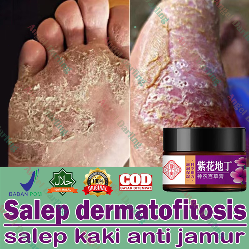 Jual Obat Kapalan Kaki Penghilang Bau Kaki Obat Jamur Kaki 30g Obat