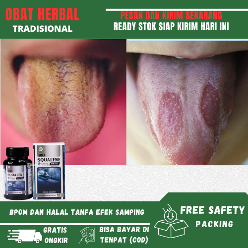 Jual Obat Mulut Pahit Karena Asam Lambung Naik, Penyakit Gerd, Mulut