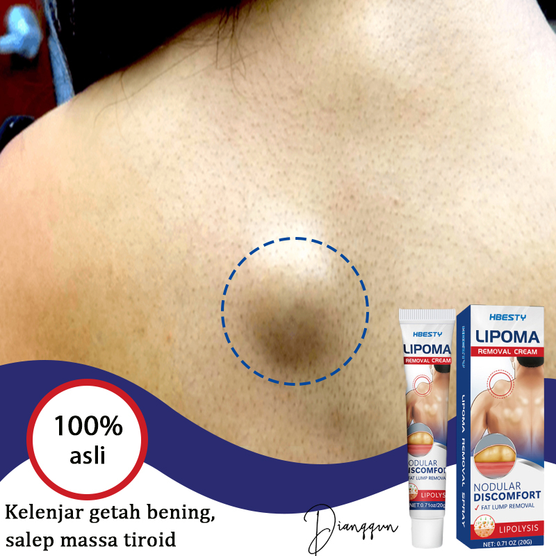 Jual Krim Lipoma Penghilang Benjolan Obat Lipoma Salep Benjolan Lipoma ...