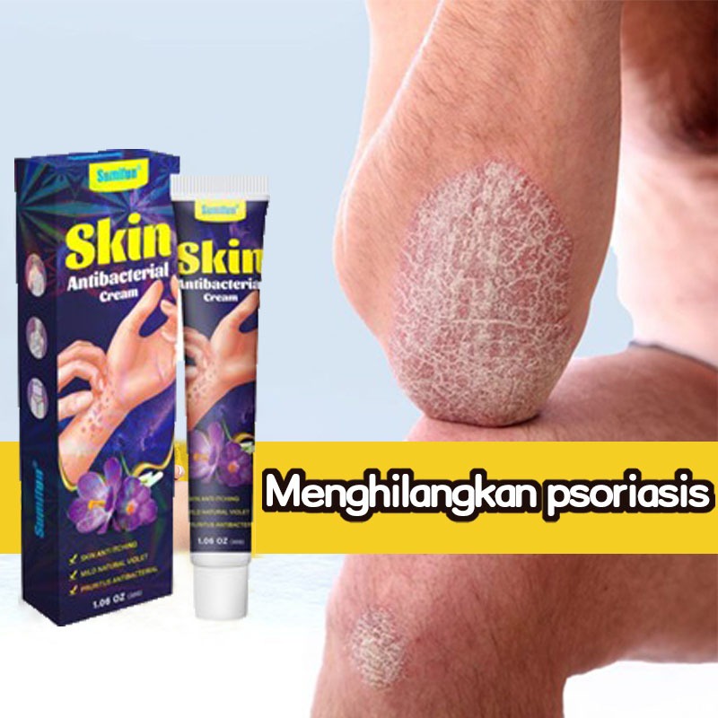 Jual salep gatal psoriasis cream salep eksim salep gatal paling ampuh